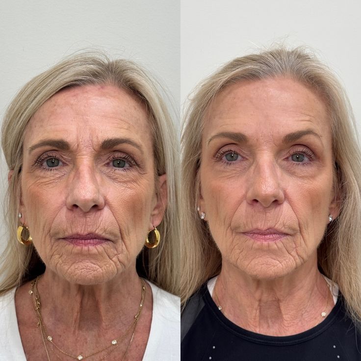 Lifting & V-Line Contouring