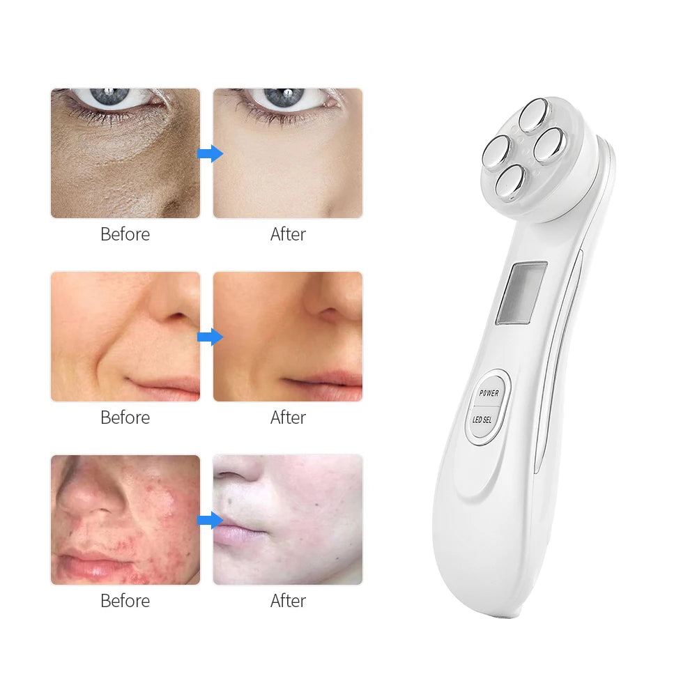 Sculptano 5-in-1 RF & EMS Deep Electroporation Facial Lifting Device